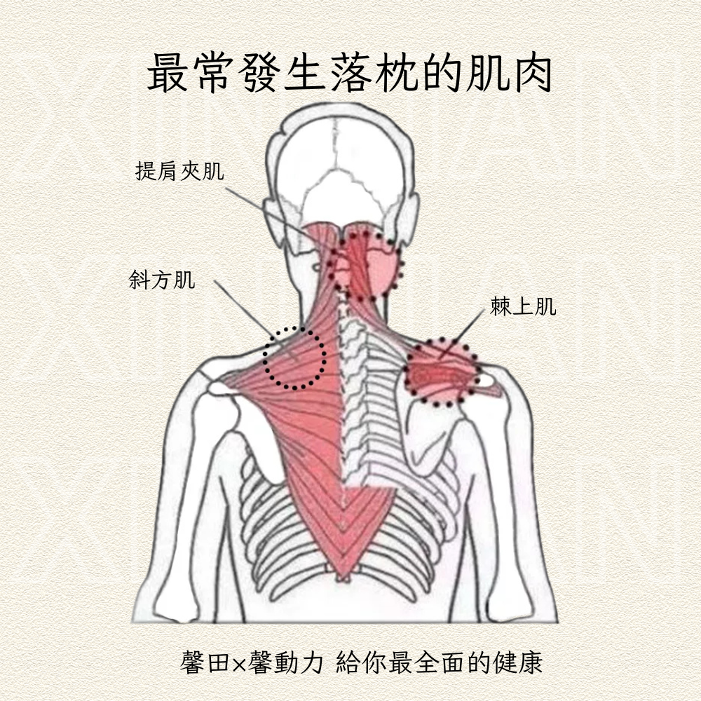 最常發生落枕的肌肉